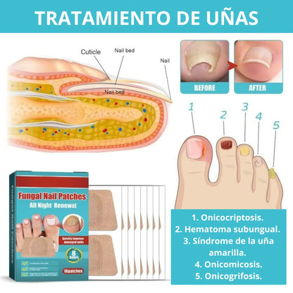 PARCHES ANTIHONGOS PARA UÑAS – PACK 3 CAJAS (48 PARCHES
